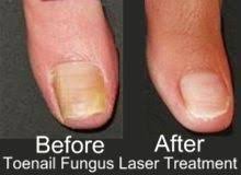 our innovative fungal nail treatment
