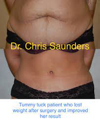 tummy tuck and weight loss when is the