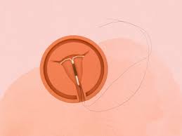 iud removal how it works and side