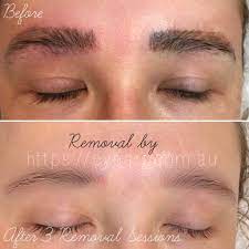 The basic tattoo removal method for your eyebrows avoids damaging your skin and is completely natural. Eyebrow Tattoo Removal Melbourne Victoria Eye Art Studio