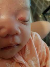 red spot on eyelid babycenter