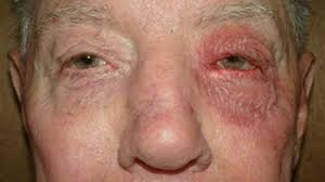 eyelid dermais treatments symptoms
