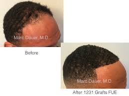 Hair restoration phoenix az by dr. Fue Hair Transplant In African American Patient Marc Dauer Md Hair Transplant Doctor Los Angeles