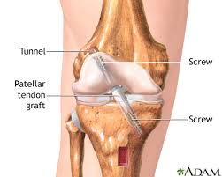 Image result for images of leg operation with screws
