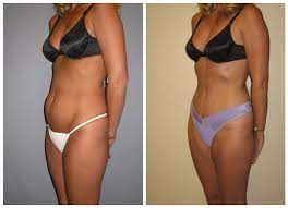 the truth about tummy tuck recovery