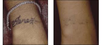 laser tattoo removal ablon skin