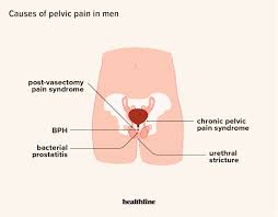 pain in pelvis 24 causes in men and