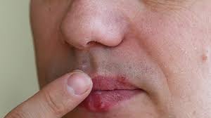 herpes simplex virus infection lips