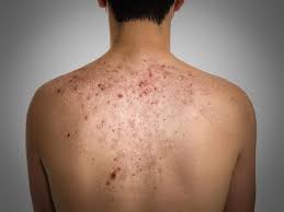 15 home remes for pimples on back