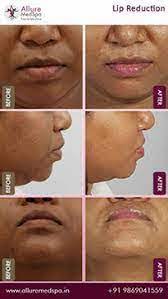 lip reduction surgery cost in mumbai