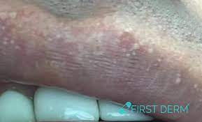 white spots on skin pictures causes