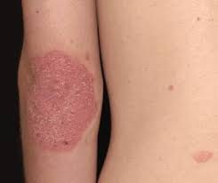 Description Of Skin Lesions Dermatologic Disorders Merck