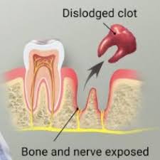 The dentist will pack a gauze pad into the socket and have you bite apply an ice bag to the affected area immediately after the procedure to keep down swelling. What Should I Do After My Wisdom Teeth Removal Ncoso