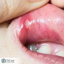 natural canker sore relief remes
