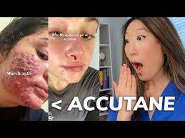 accutane expert dermatologist insights