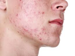 what is cystic acne and why is it