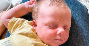 top tips to help with baby acne