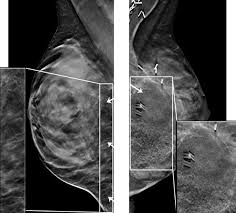 Daye Digital Breast Tomosynthesis Findings After Surgical