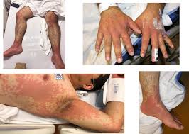 prominent rash and multisystem