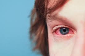 allergy management and your eyes the