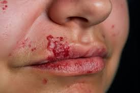 a woman with red spots on her lips