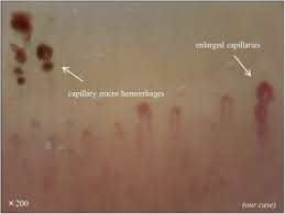 nailfold videocapillaroscopy