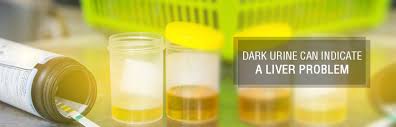 dark urine can indicate a liver problem