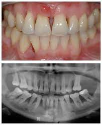 Periodontal diseases alters the morphological features of the bone in addition to reducing bone height. Rebuilding Bone Loss In Gums Blog Advanced Dentistry