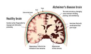 alarm alzheimer s disease