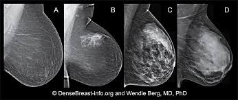 Dense Breast Tissue Dense Breasts Densebreast Info