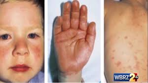 The issue is that covid can cause a wide variety of skin signs and symptoms, which is why there has been a delay in recognising that these various skin in this blog we will focus on the three main types of skin rashes associated with covid: La Reports 4th Death Tied To Child Illness Possibly Linked To Covid 19