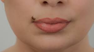 a mole on your lip