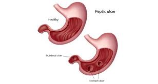 peptic ulcer health tips peptic