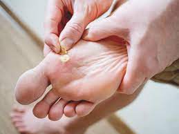 how to avoid and treat plantar warts