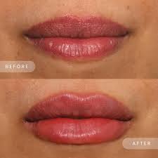 restylane kysse lip injections long