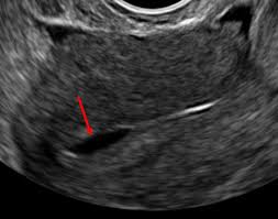 frozen embryo transfer fet what can