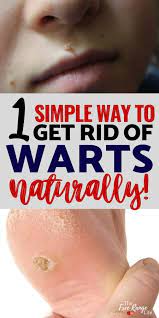 get rid of warts naturally