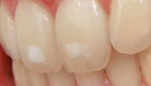 white spots on teeth 11 tips on how to