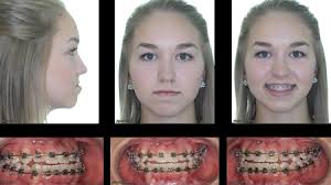 basics of corrective jaw surgery