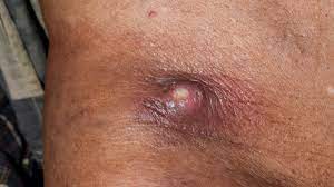skin abscess causes diagnosis and