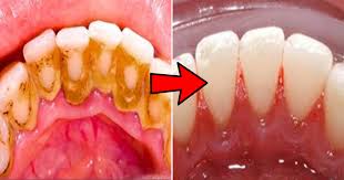 Worn frequently, the night guards and mouth guards can become smelly and filled with calcium and plaque, which is a constant deposit of to clean a mouth guard, start by pouring a little bit of dish soap on it. How To Remove Tartar From Teeth Yourself Reddit Teethwalls
