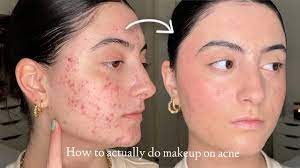 acne and textured skin