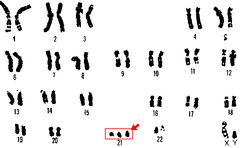 Witam, zespół downa czyli trisomia 21 chromosomu to schorzenie wynikające z nieprawidłowego podziału materiału genetycznego. Zespol Downa Wikipedia Wolna Encyklopedia