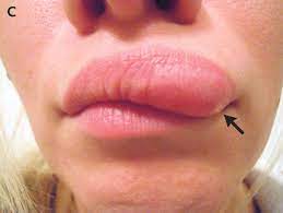moving lump in woman s face was a worm