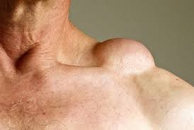 lump on shoulder causes diagnosis