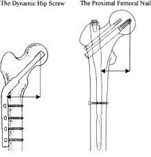 ao asif proximal fem nail pfn
