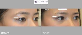 before and after asian blepharoplasty