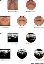 cleft lip and palate understanding