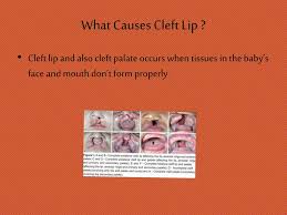 ppt cleft lip palate powerpoint