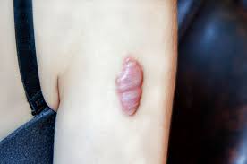 piercing p vs keloid symptoms